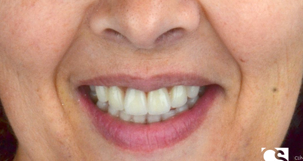 Implant-dentaire-portugal-apres