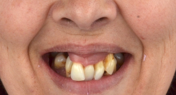 Implant-dentaire-portugal-avant
